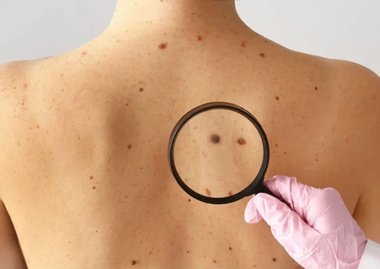 Skin Cancer